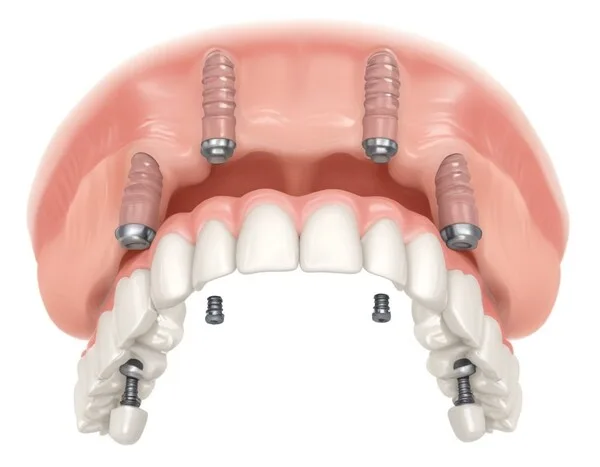 mpianti dentali All on Four