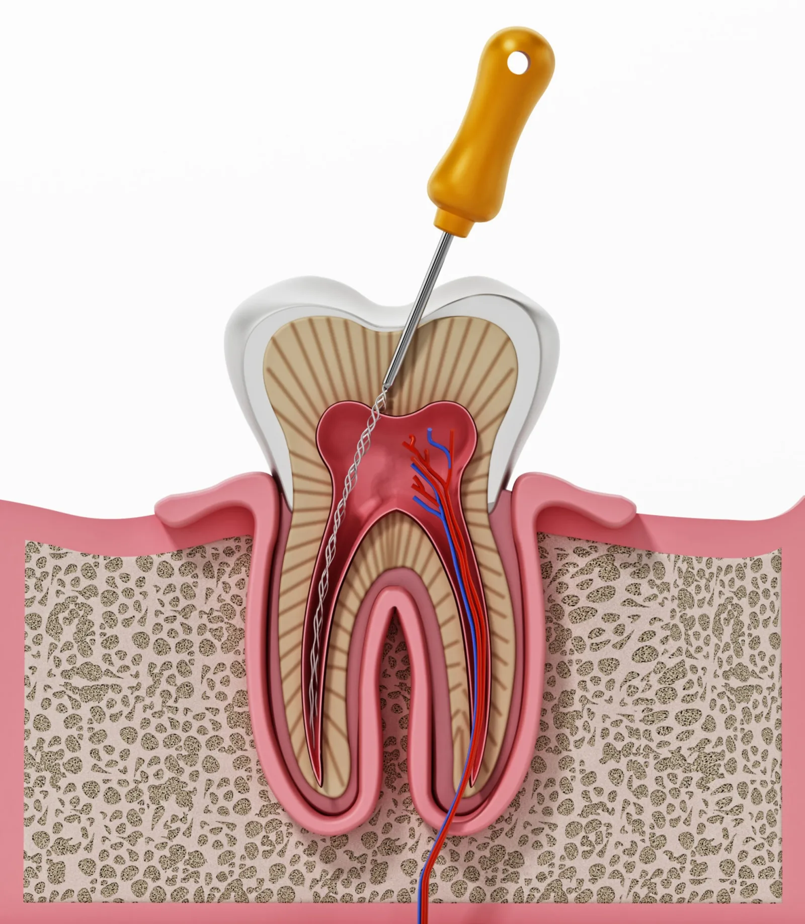 Cura Canalare e Devitalizzazione Roma - Studio Dentistico
