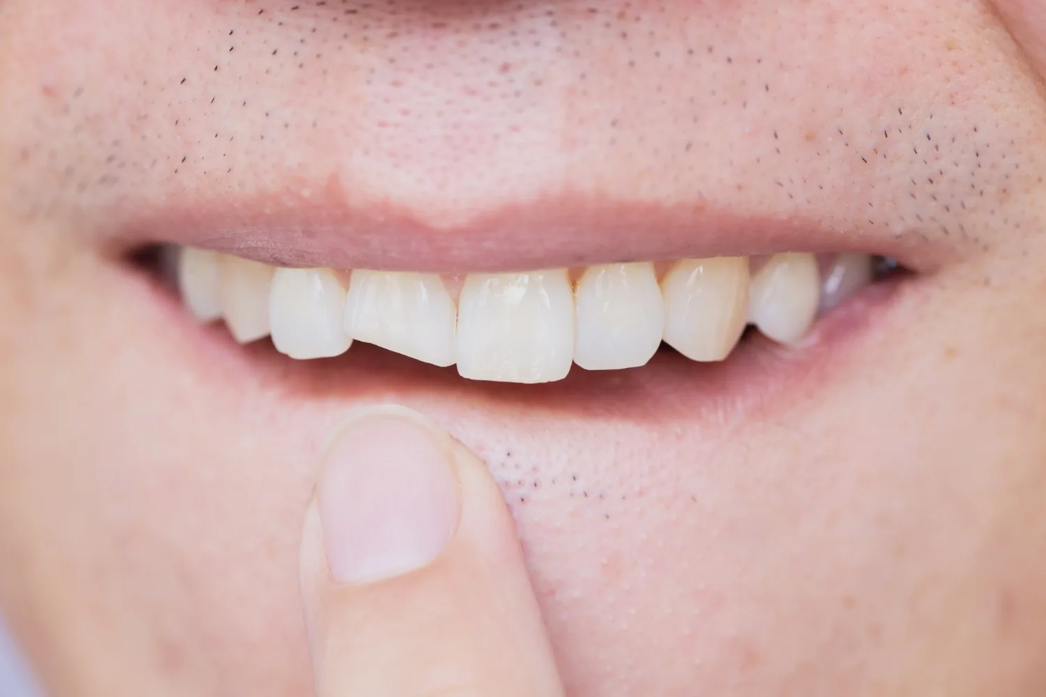 Denti Rotti o Scheggiati Dentista Roma