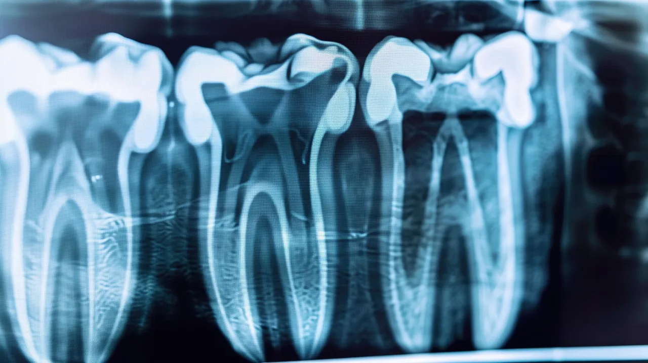 Devitalizzazione Dente Roma