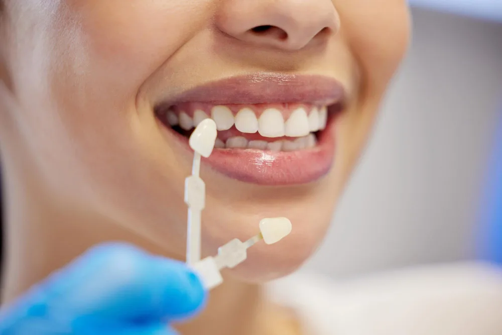 Faccette Dentali
