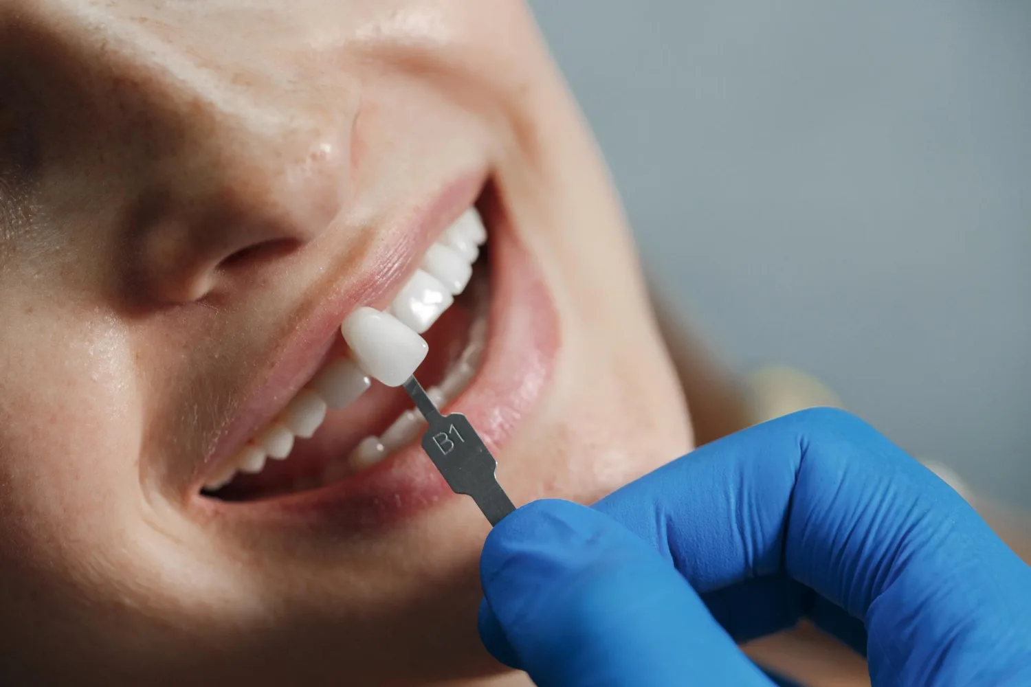 Faccette Dentali Parioli Salaria Prati