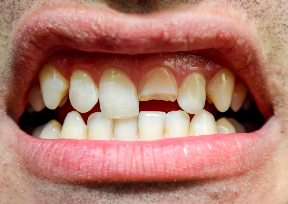 Riparazione Dente Spezzato