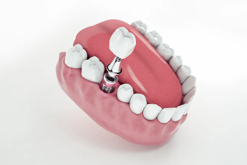 Studio Dentistico Implantologia Dentale Roma