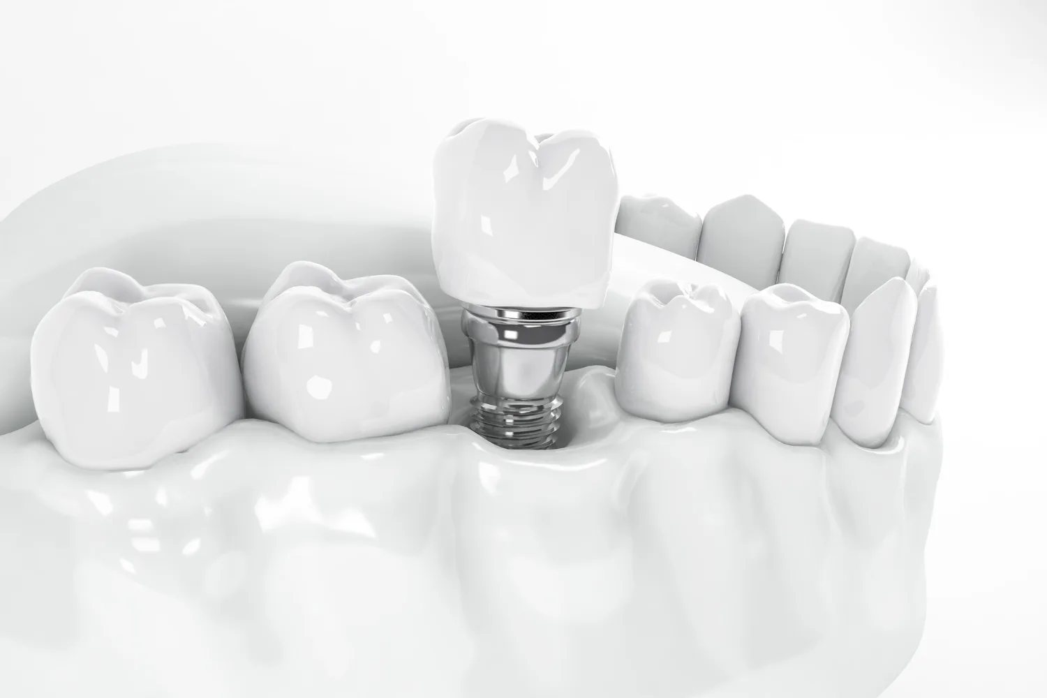 Protesi Dentale - Studio Dentistico Roma Centro