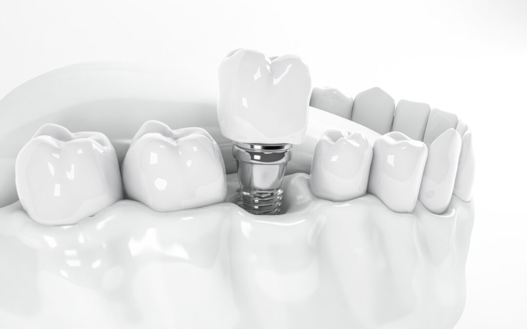 Protesi Dentale - Studio Dentistico Roma Centro