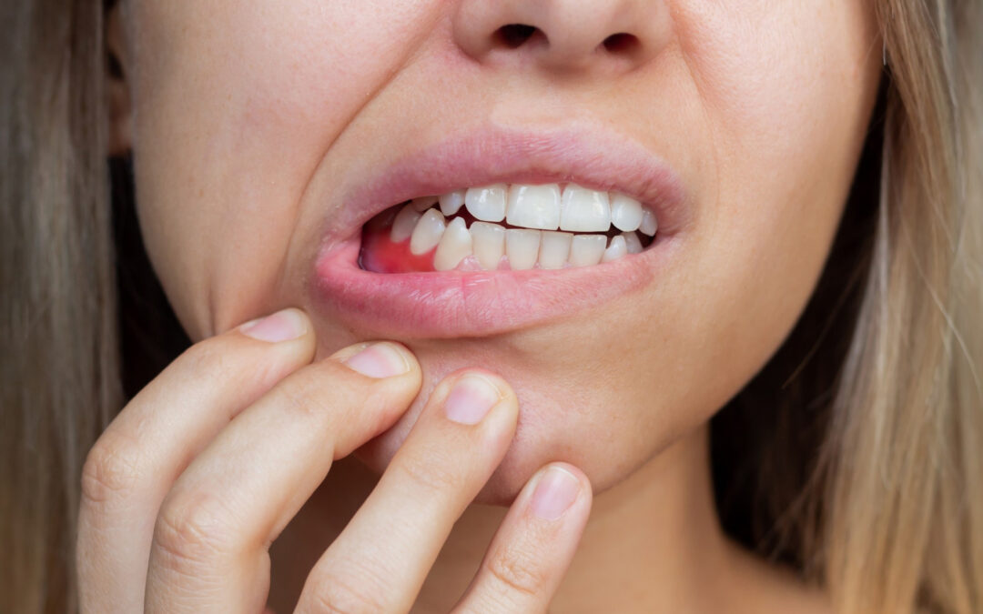 Prevenzione Parodontite Roma - Studio Dentistico
