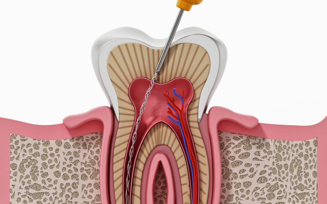Cura Canalare e Devitalizzazione Roma - Studio Dentistico