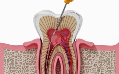 Trattamento Canalare: la Guida Completa alla Conservazione Dentale