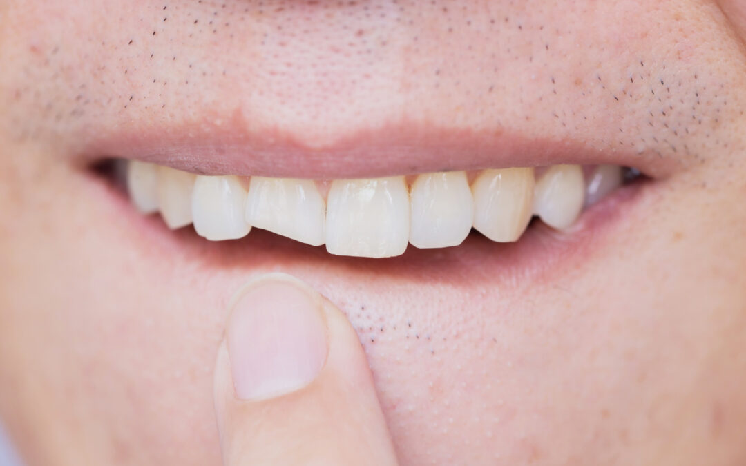 Denti Rotti o Scheggiati Dentista Roma