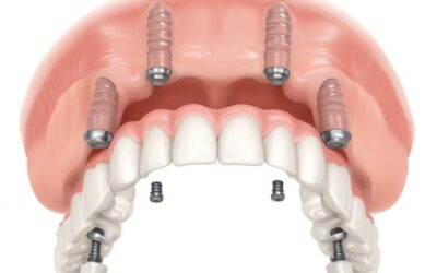 Impianti Dentali All-On-Four a Roma Centro Sostituzione Rapida di Intere Arcate Dentali