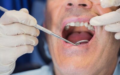 Dente Annerito? Ecco Cosa Può Fare il Dentista per Te