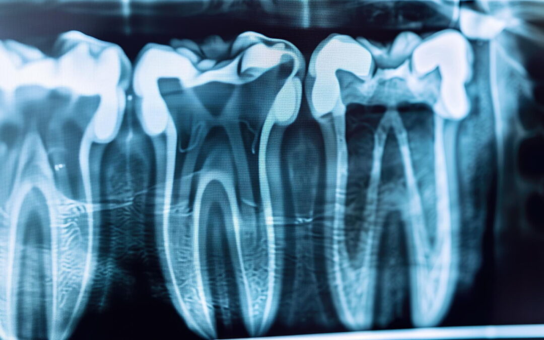 Devitalizzazione del Dente: Quando è Necessaria e Come si Svolge