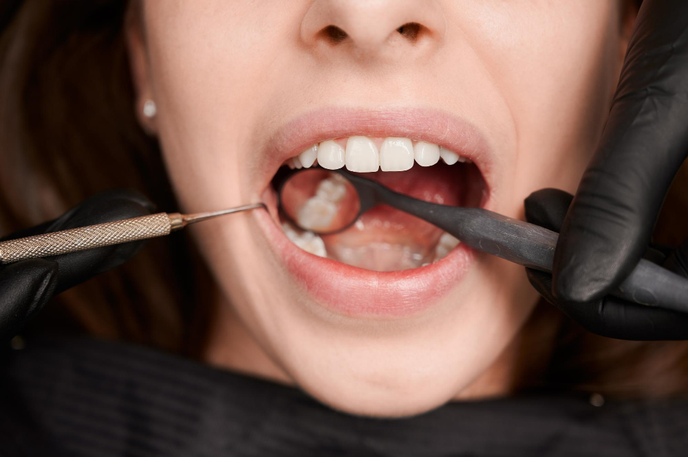 Le sigillature dentali funzionano anche negli adulti?
